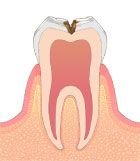 C2のむし歯治療